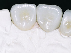 Porcelanas odontológicas: muita história para contar aos mais novos