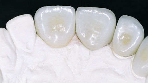 Porcelanas odontológicas: muita história para contar aos mais novos