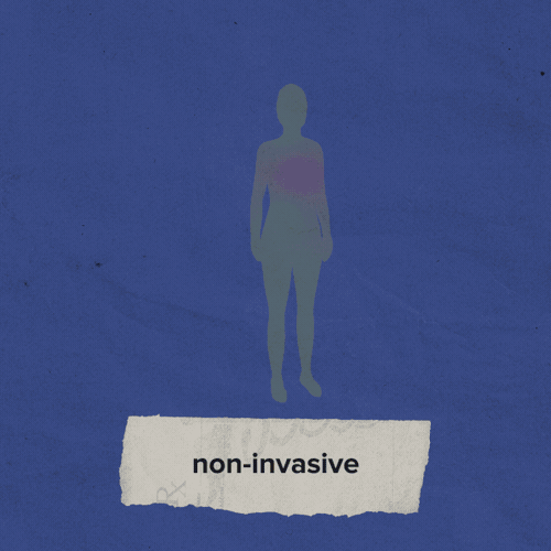 Medical News Today: Early Stage Breast Cancer