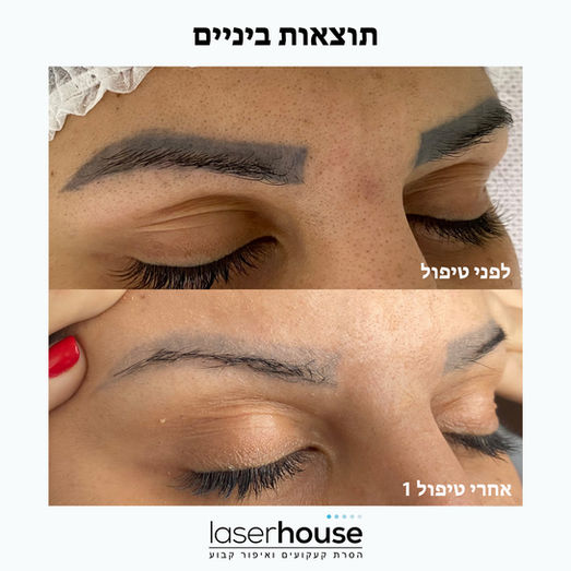 הסרת גבות בלייזר
הסרת קעקוע גבות בלייזר
הסרת איפור גבות
פורום הסרת איפור קבוע גבות
נטרול איפור קבוע
הסרת גבות בלייזר בחיפה
הסרת קעקועים בקריות חיפה
הסרת איפור גבות