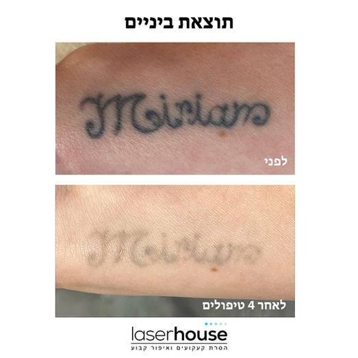 הסרת קעקועים בלייזר במינימום טיפולים, ללא כוויות ופיגמנטציה