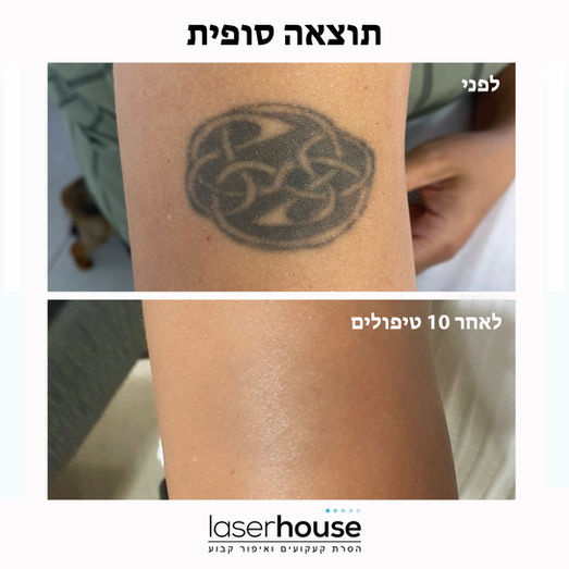 מחיקת קעקוע ישן באזור הזרוע במרכז הארץ