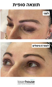 לפני ואחרי הסרת מיקרופיגמנטציה בגבות ב-4 טיפולי לייזר בתל אביב – עור נקי