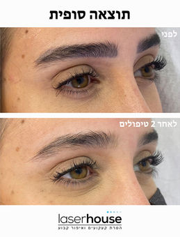 איפור קבוע בגבות לפני ואחרי 2 טיפולי לייזר בתל אביב – הסרה מלאה עד לעור נקי