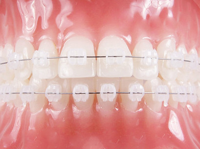 Ceramic Braces