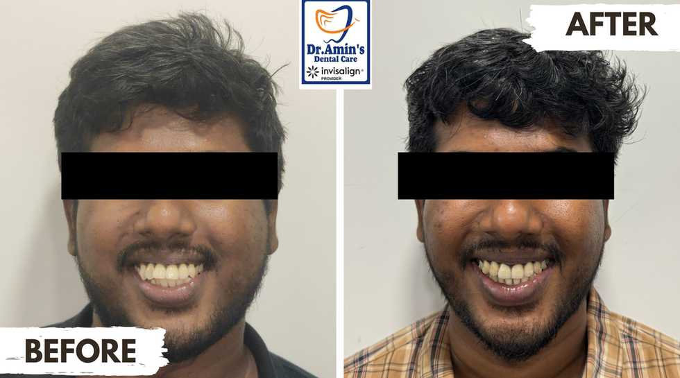 Invisalign Smile