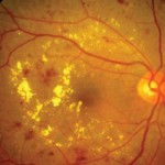 Retinopatia-diabetica2-150x150.jpeg