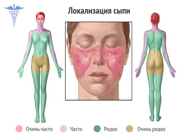 Системная Красная Волчанка Фото