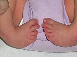 Clubfoot in Babies (CTEV): Ghabrane Ki Baat Nahi, Sahi Ilaaj Hai Mumkin | Pediatric Orthopedics Noida