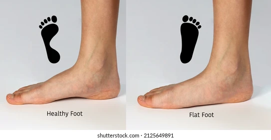 क्या आपके बच्चे के पैर चपटे (Flat Feet) हैं? माता-पिता के लिए एक संपूर्ण गाइड