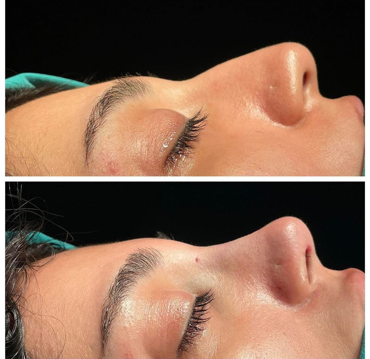 needle less rhinoplasty