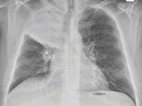 What is a collapsed lung?