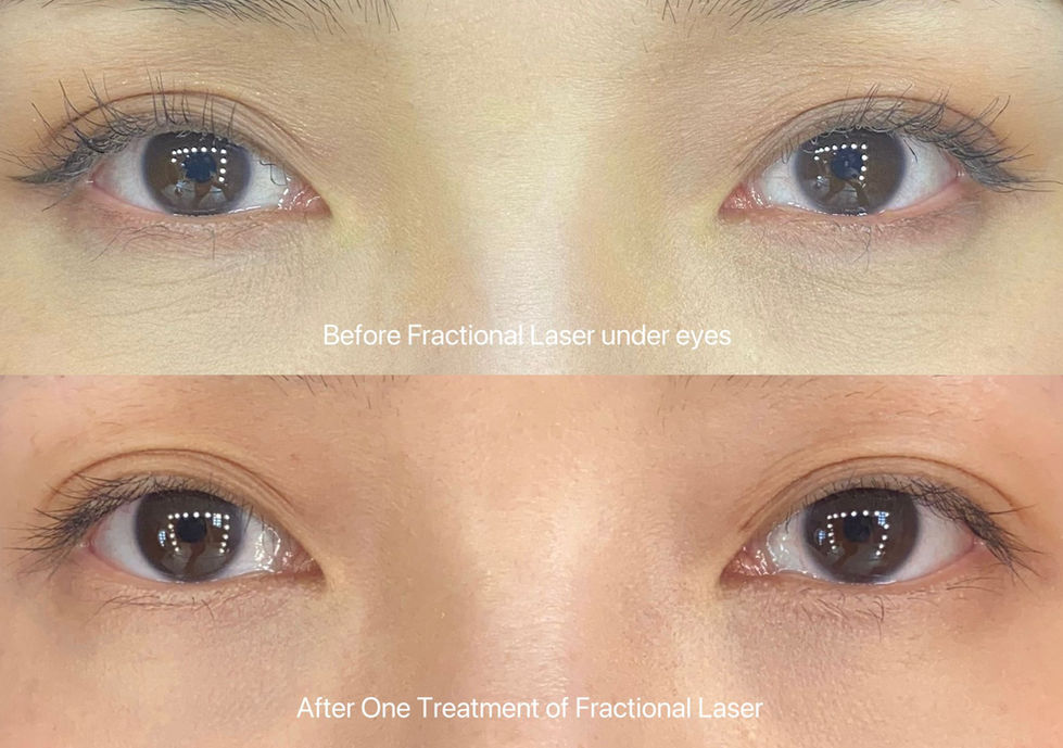 fractional laser with smootheye.jpg