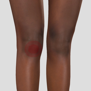 staw rzepkowo-kolanowy