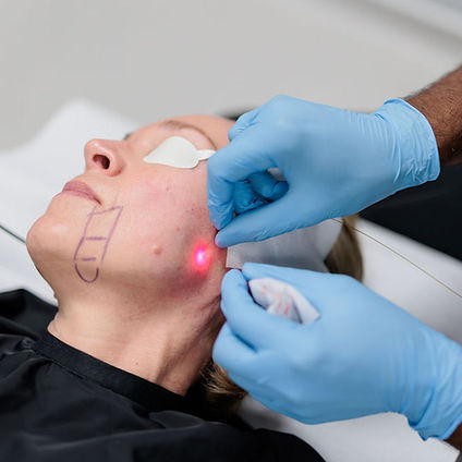 endolift procedure in dublin