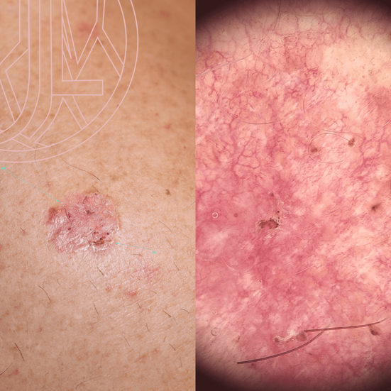 dermatoscopia