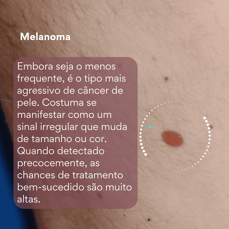 tipos de câncer de pele