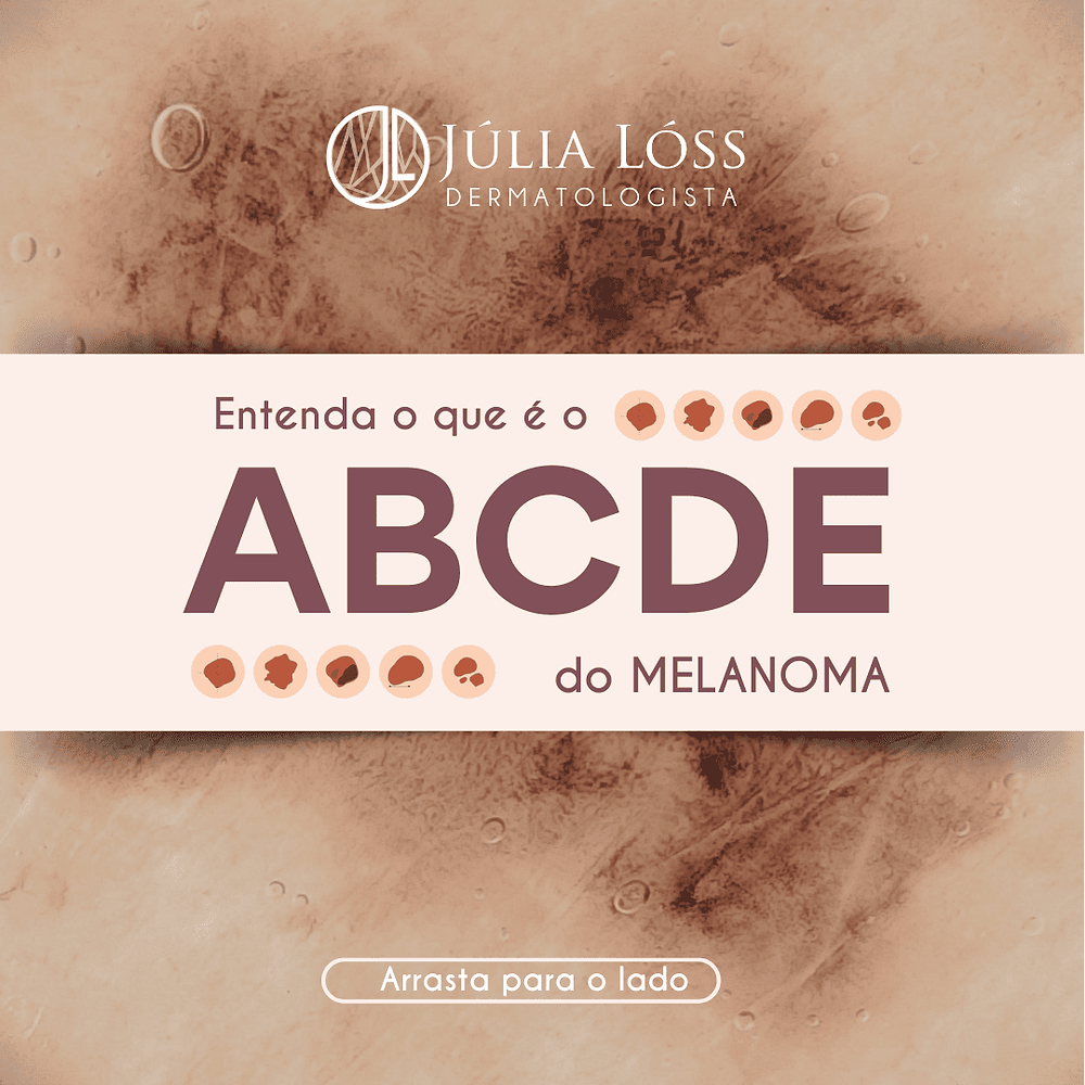 ABCDE DO MELANOMA