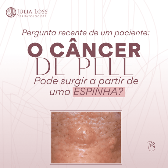 câncer de pele