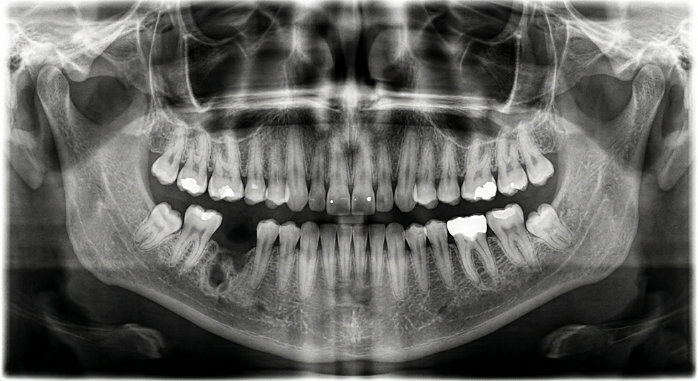 Exemplo de radiografia panorâmica com perda óssea no Brooklin Sp.