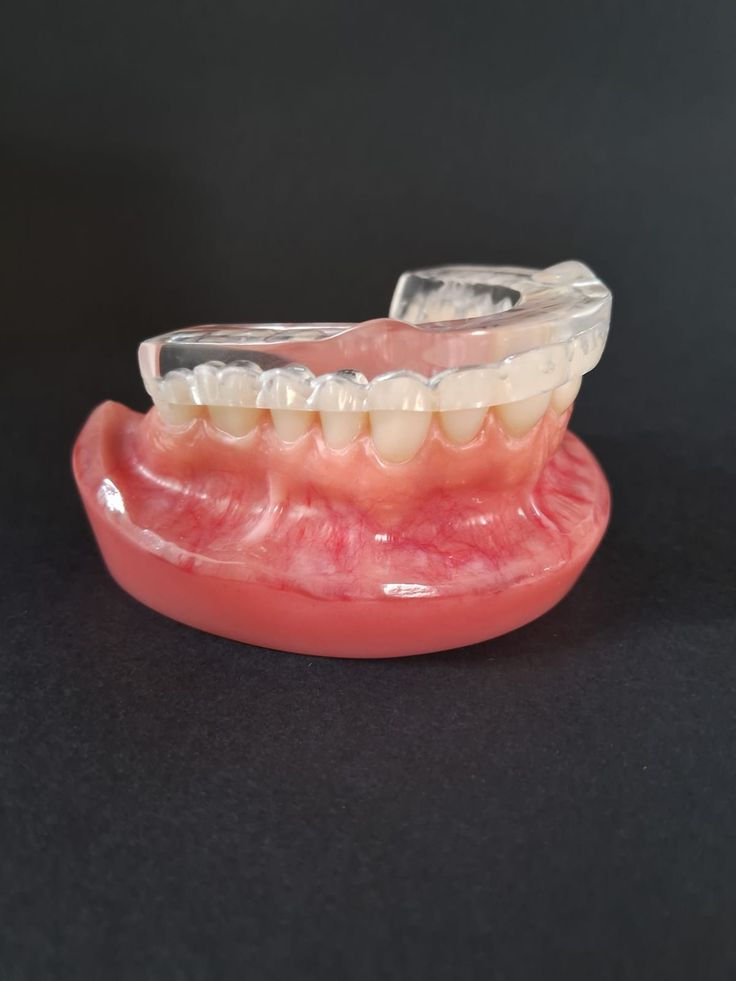 Exemplo de placa miorrelaxante de acrílico usada para ajudar no tratamento de dores de ATM no Brooklin zona sul de SP. 