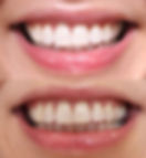 Clareamento dental no Brooklin SP