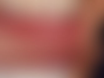 Resultado final do tratamento com Lentes no Brooklin Sp. 