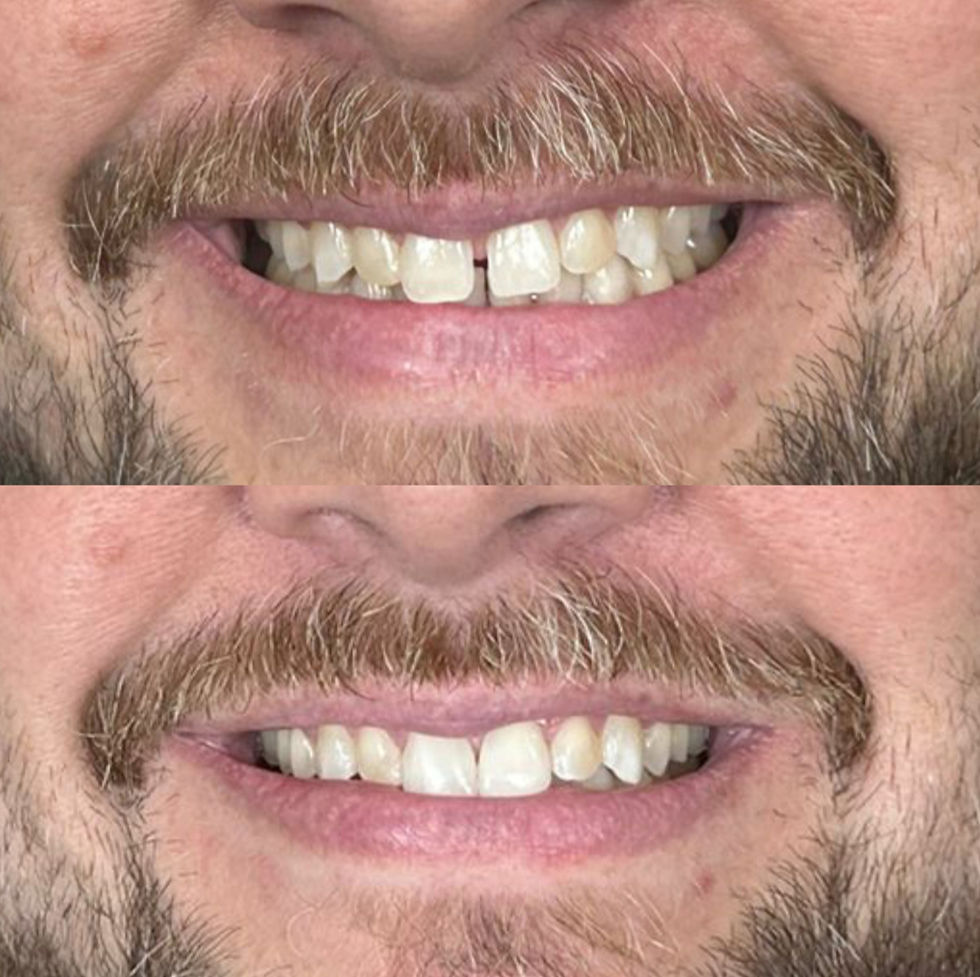 Paciente antes e depois de fazer o tratamento na BCX Odontologia no Brooklin SP