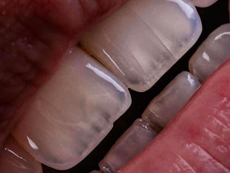 Dente com microfissura visível causada por bruxismo, avaliação odontológica em clínica especializada no Brooklin São Paulo