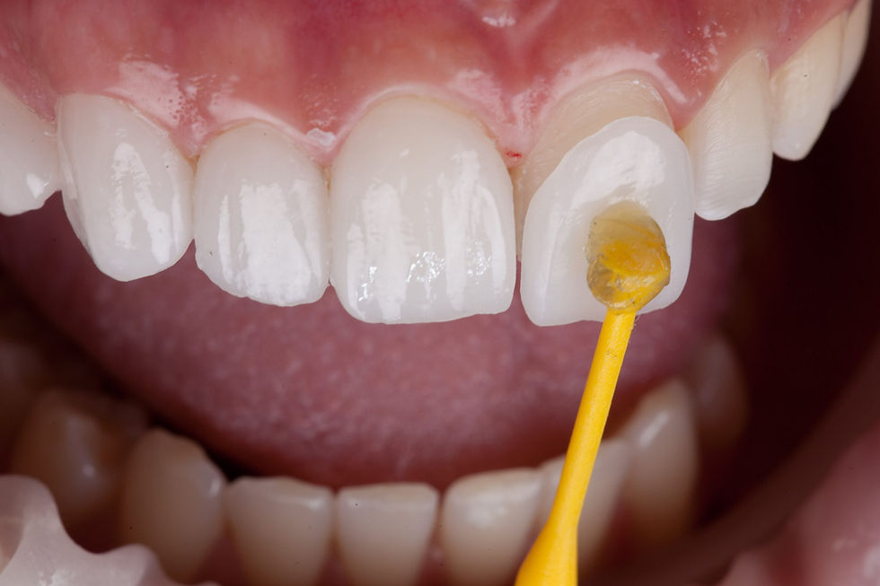 Do Veneers Look Fake? The Real Reasons Some Smiles Don't Look Natural
