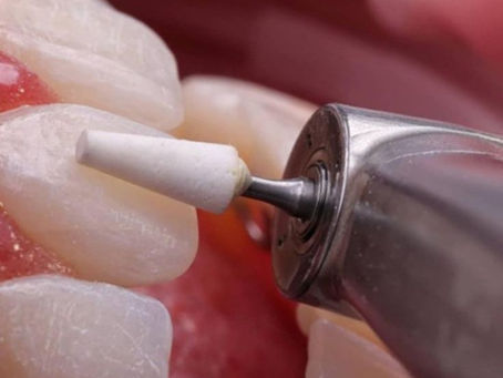 Exemplo de como e feito o polimento das facetas no Brooklin Sp.