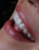 Patient smiling naturally after treatment with veneers in Brooklin, SP.