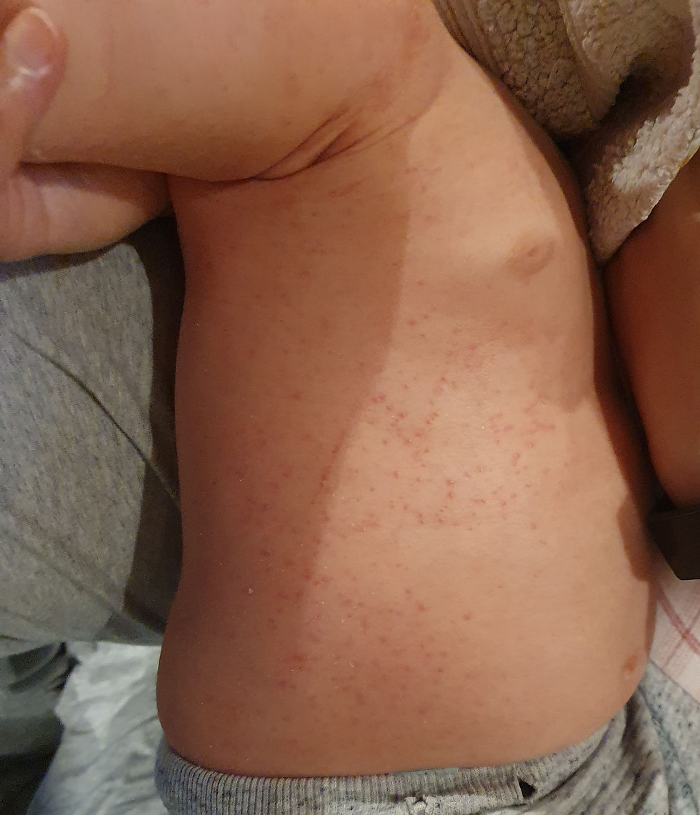 A baby's naked torso with a spotty rash on it - symptoms from reintroducing allergens during the Elimination Diet.
