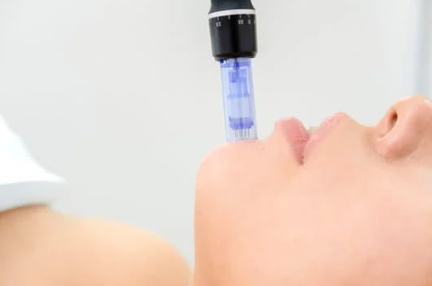 Avant après d'une peau avec cicatrices atrophiées et une peau neuve sur la seconde photo