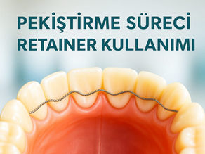 Retainer (Pekiştirme) Süreci: Neden Önemli ve Nasıl Kullanılır?