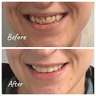 SKYS Composite Fillings