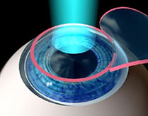 IMAGE SYNTHESE LASIK CAPOT.jpg