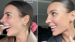 Influencer Indy Clinton Finally Shares Her Second Nose Job Results and Addresses Controversy Over Charging for the Full Story