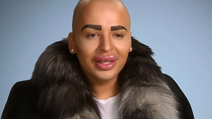 Jordan James Parke’s Final Chapter Was Marked by Warnings About His Plastic Surgery Addiction