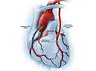 Mics Total Arterial CABG.webp