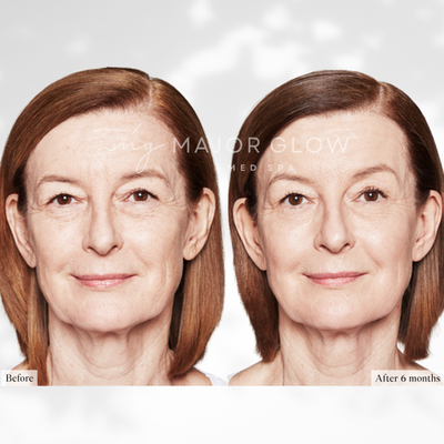 Mid- and Lower-Face Rejuvenation at MajorGlow Med Spa in San Mateo