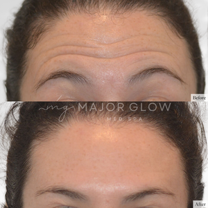 Forehead Lines at MajorGlow Med Spa in San Mateo