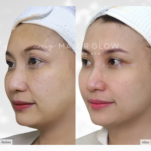 RF Microneedling – Texture and Pigmentation at MajorGlow Med Spa in San Mateo
