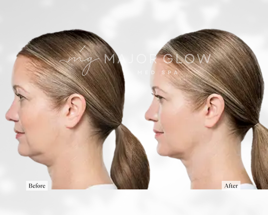 Neck and Chin Refinement at MajorGlow Med Spa in San Mateo