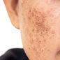 melasma_edited.jpg