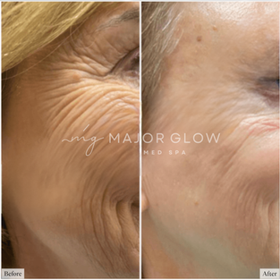 RF Microneedling – Facial Skin Rejuvenation at MajorGlow Med Spa in San Mateo