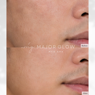 Microneedling – Enlarged Pores at MajorGlow Med Spa in San Mateo