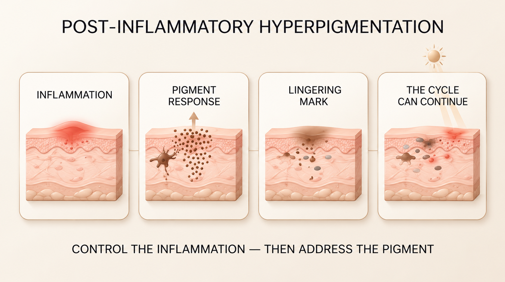 Educational illustration showing inflammation, pigment response, lingering discoloration, and the cycle of post-inflammatory hyperpigmentation