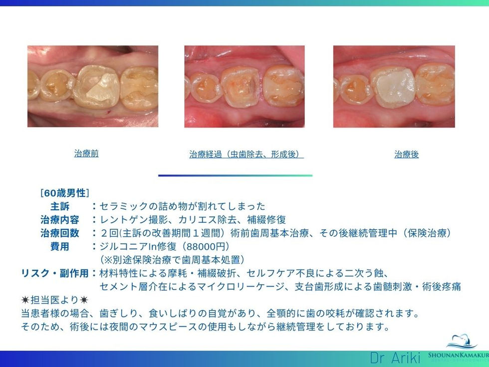 湘南鎌倉歯科・矯正歯科｜割れたセラミックをジルコニアで修復した症例