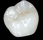 EmaxDentalCrowns.jpeg